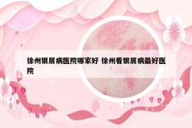 徐州银屑病医院哪家好 徐州看银屑病最好医院