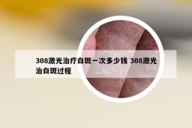 308激光治疗白斑一次多少钱 308激光治白斑过程