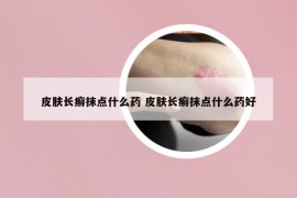 皮肤长癣抹点什么药 皮肤长癣抹点什么药好