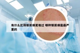 有什么比得银屑病更难过 哪种银屑病是最严重的
