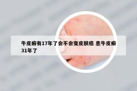 牛皮癣有17年了会不会变皮肤癌 患牛皮癣31年了