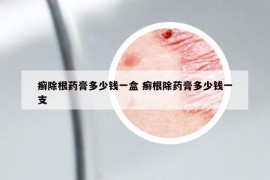 癣除根药膏多少钱一盒 癣根除药膏多少钱一支