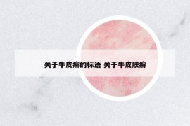关于牛皮癣的标语 关于牛皮肤癣