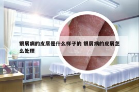银屑病的皮屑是什么样子的 银屑病的皮屑怎么处理