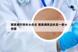银屑病不停长小点点 银屑病旁边长出一些小疙瘩