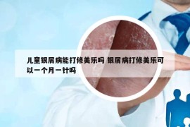 儿童银屑病能打修美乐吗 银屑病打修美乐可以一个月一针吗