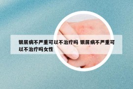 银屑病不严重可以不治疗吗 银屑病不严重可以不治疗吗女性