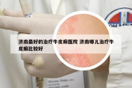济南最好的治疗牛皮癣医院 济南哪儿治疗牛皮癣比较好