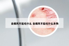 自癜风不能吃什么 自癜风不能吃什么食物