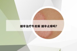 细辛治疗牛皮癣 细辛止痒吗?