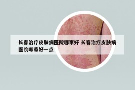 长春治疗皮肤病医院哪家好 长春治疗皮肤病医院哪家好一点