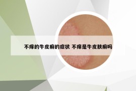 不痒的牛皮癣的症状 不痒是牛皮肤癣吗