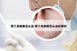 得了皮肤癣怎么治 得了皮肤癣怎么治好得快
