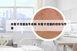 木鳖子泡酒治牛皮癣 木鳖子泡酒的功效与作用