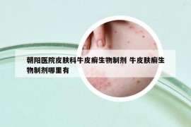 朝阳医院皮肤科牛皮癣生物制剂 牛皮肤癣生物制剂哪里有
