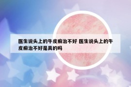 医生说头上的牛皮癣治不好 医生说头上的牛皮癣治不好是真的吗