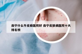 南宁什么牛皮癣医院好 南宁皮肤病医院十大排名榜