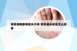 银屑病哪都痒就头不痒 银屑病头痒是怎么回事