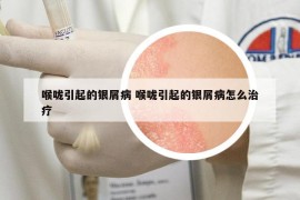 喉咙引起的银屑病 喉咙引起的银屑病怎么治疗