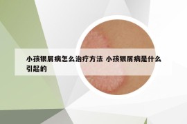小孩银屑病怎么治疗方法 小孩银屑病是什么引起的