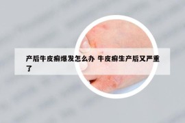 产后牛皮癣爆发怎么办 牛皮癣生产后又严重了
