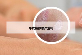 牛皮癣都很严重吗