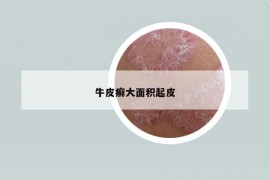 牛皮癣大面积起皮