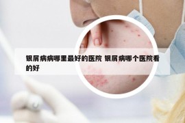 银屑病病哪里最好的医院 银屑病哪个医院看的好