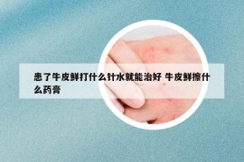 患了牛皮鲜打什么针水就能治好 牛皮鲜擦什么药膏