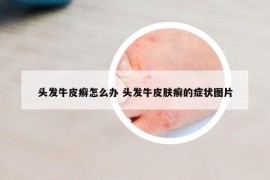 头发牛皮癣怎么办 头发牛皮肤癣的症状图片