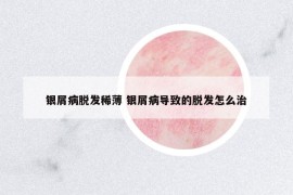银屑病脱发稀薄 银屑病导致的脱发怎么治
