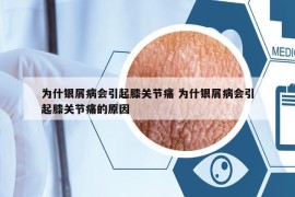 为什银屑病会引起膝关节痛 为什银屑病会引起膝关节痛的原因