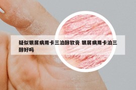 疑似银屑病用卡三泊醇软膏 银屑病用卡泊三醇好吗