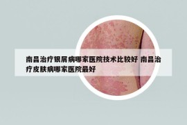 南昌治疗银屑病哪家医院技术比较好 南昌治疗皮肤病哪家医院最好