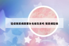 轻症银屑病需要补充维生素吗 银屑病轻微