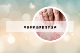 牛皮癣和湿疹有什么区别