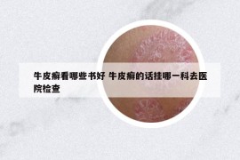 牛皮癣看哪些书好 牛皮癣的话挂哪一科去医院检查