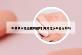 喝黄芪水能治银屑病吗 黄芪泡水喝能治癣吗