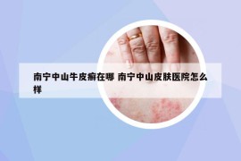 南宁中山牛皮癣在哪 南宁中山皮肤医院怎么样