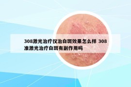 308激光治疗仪治白斑效果怎么样 308准激光治疗白斑有副作用吗