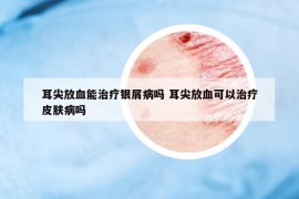 耳尖放血能治疗银屑病吗 耳尖放血可以治疗皮肤病吗