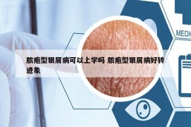 脓疱型银屑病可以上学吗 脓疱型银屑病好转迹象