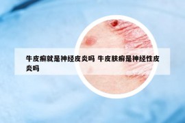 牛皮癣就是神经皮炎吗 牛皮肤癣是神经性皮炎吗