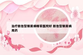 治疗脓包型银屑病哪家医院好 脓包型银屑病用药