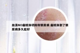 血清NO扁桃体切除和银屑病 扁桃体割了银屑病多久能好