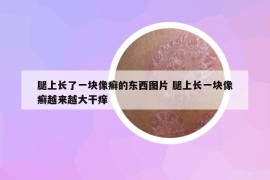 腿上长了一块像癣的东西图片 腿上长一块像癣越来越大干痒