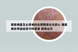 银屑病是怎么得来的去择西安北方舒心 银屑病会传染给孩子吗采用 西安北方