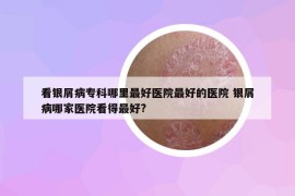 看银屑病专科哪里最好医院最好的医院 银屑病哪家医院看得最好?