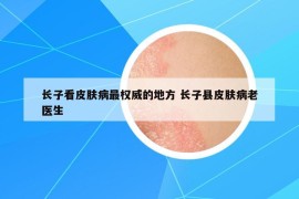 长子看皮肤病最权威的地方 长子县皮肤病老医生
