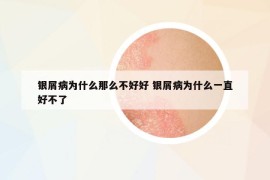 银屑病为什么那么不好好 银屑病为什么一直好不了
